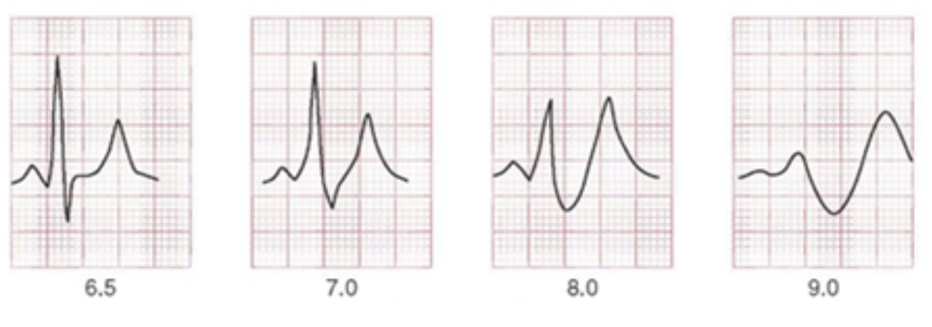 Severe hyperkalaemia